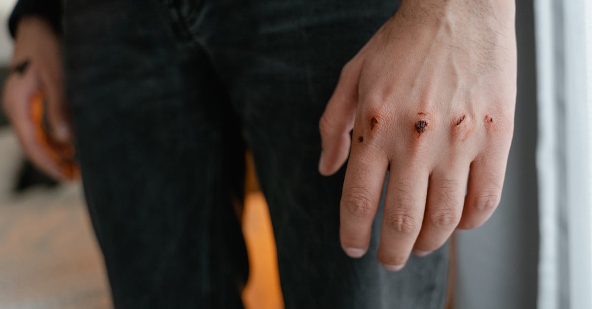 découvrez comment traiter et prévenir les égratignures avec nos conseils pratiques. apprenez les meilleures techniques pour soigner la peau et garantir une guérison rapide. protégez-vous des égratignures grâce à nos astuces adaptés à chaque situation.